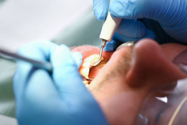 Best Emergency Dentist for Lost Fillings or Crowns in Erwin, NC